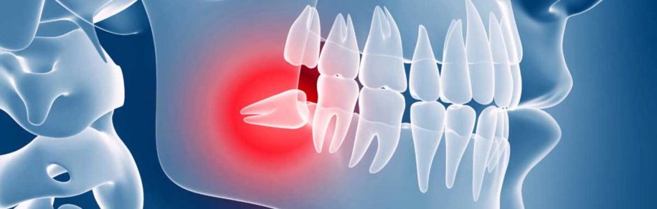 Wisdom tooth extraction: The ultimate fright in the Dental chair